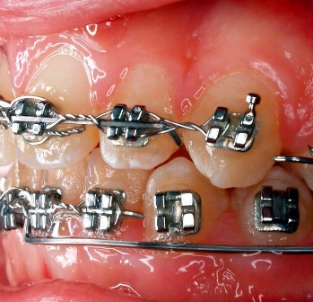 braces - from Bing search public domain image